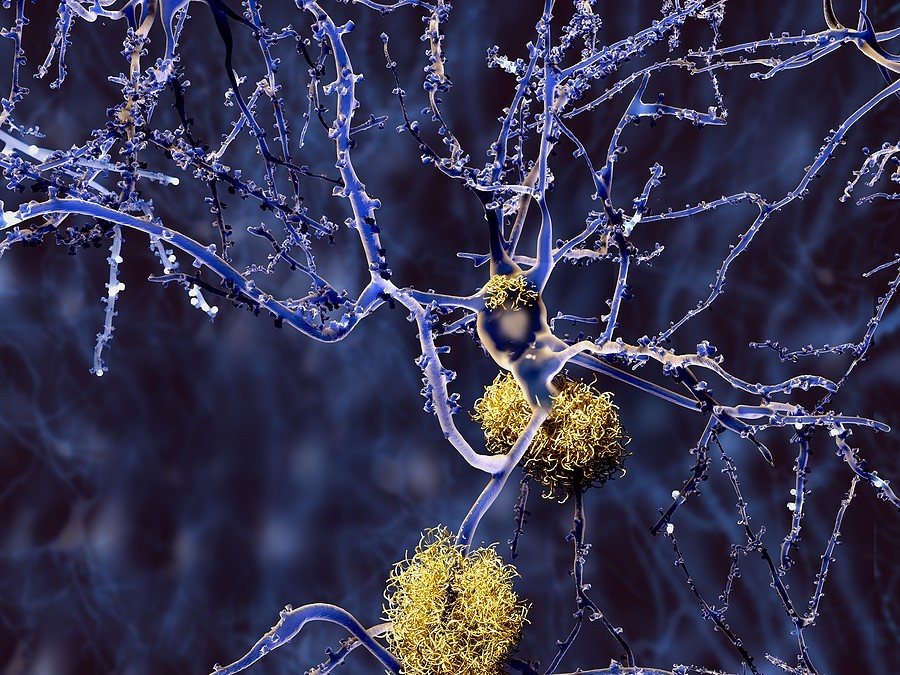 Neuron with amyloid plaques